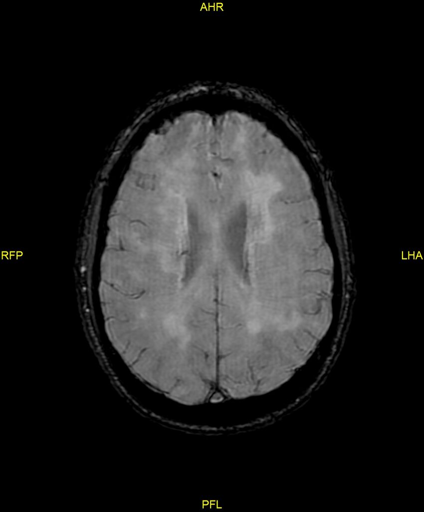 Cerebral autosomal dominant arteriopathy with subcortical infarcts and leukoencephalopathy (CADASIL) (Radiopaedia 86108-102054 Axial SWI 71).jpg