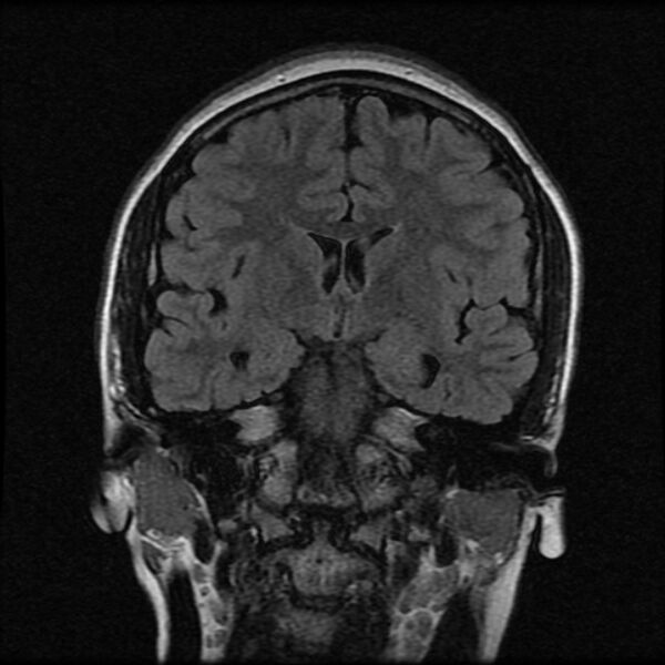 File:Cerebral cavernous malformation (Radiopaedia 44301-47942 Coronal FLAIR 9).jpg