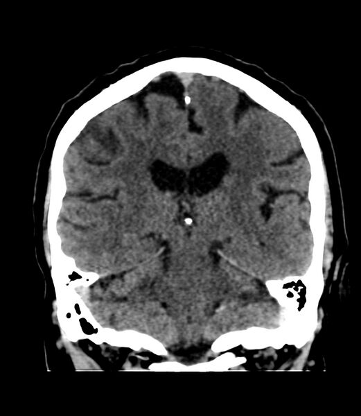 File:Cerebral dural venous sinus thrombosis (Radiopaedia 86514-102575 Coronal non-contrast 30).jpg