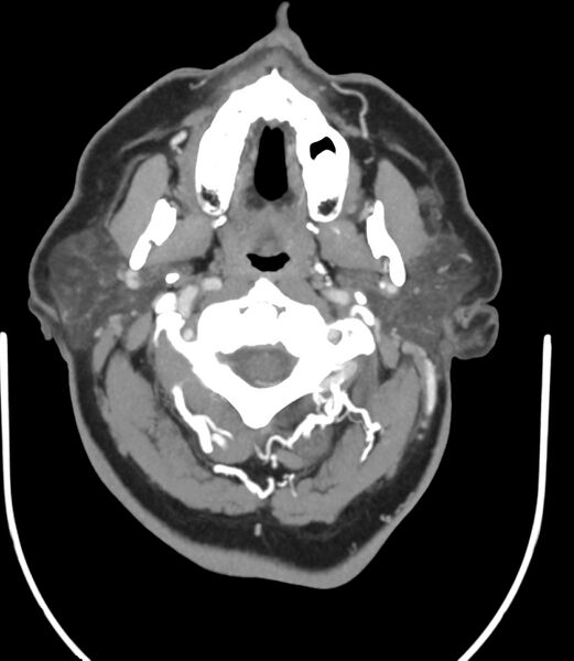File:Cerebral dural venous sinus thrombosis (Radiopaedia 86514-102576 A 17).jpg