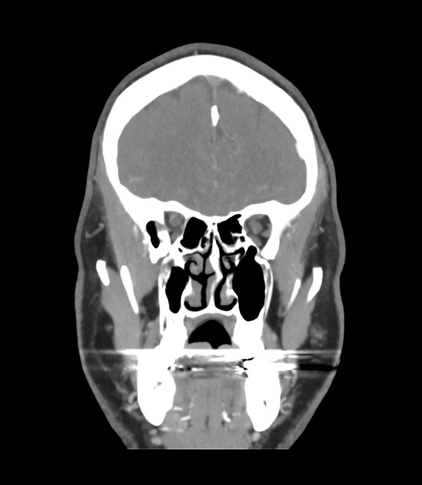 Cerebral dural venous sinus thrombosis (Radiopaedia 86514-102576 B 12).jpg