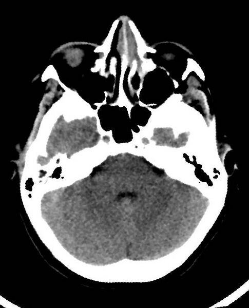 File:Cerebral edema due to severe hyponatremia (Radiopaedia 89826-106938 Axial non-contrast 29).jpg