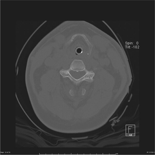 File:Cerebral hemorrhagic contusions and cervical spine fractures (Radiopaedia 32865-33841 C 15).jpg