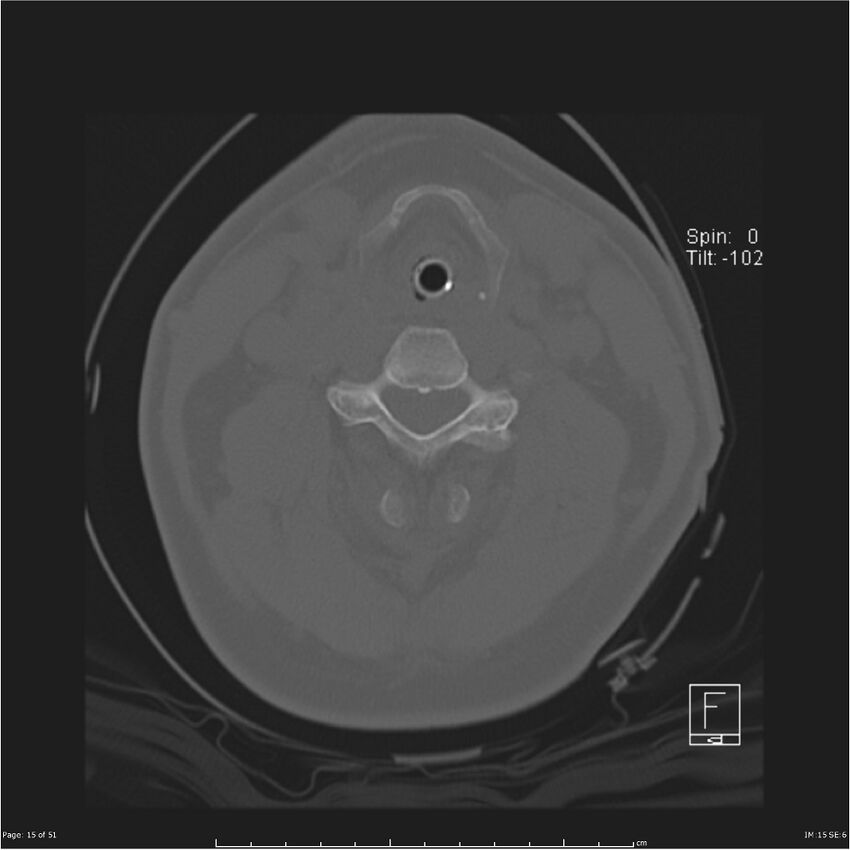 Cerebral hemorrhagic contusions and cervical spine fractures (Radiopaedia 32865-33841 C 15).jpg