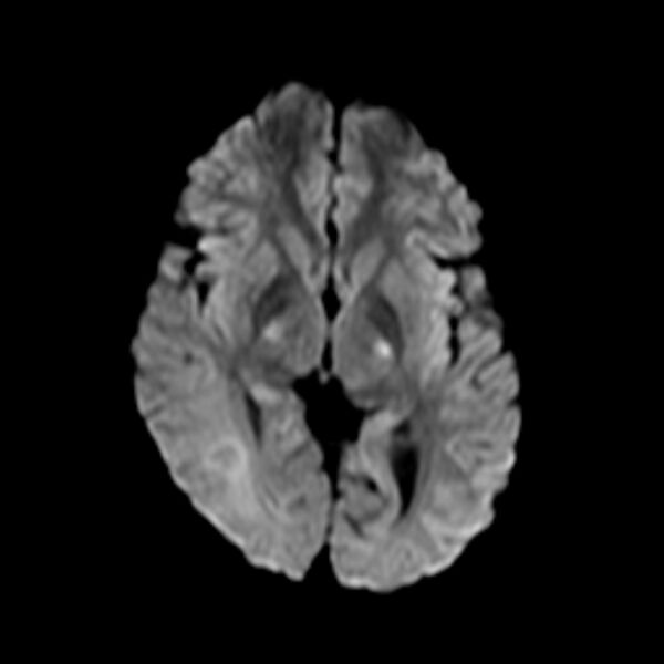 File:Cerebral tuberculoma (Radiopaedia 41152-43932 Axial DWI 10).jpg