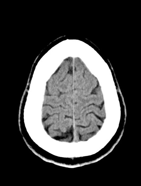 File:Cerebral venous angioma (Radiopaedia 69959-79977 Axial non-contrast 27).jpg