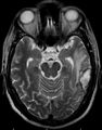Cerebral venous infarction (Radiopaedia 10746-11206 Axial T2 1).JPG
