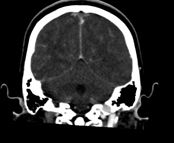 File:Cerebral venous sinus thrombosis (Radiopaedia 59224-66646 Coronal C+ delayed 54).jpg