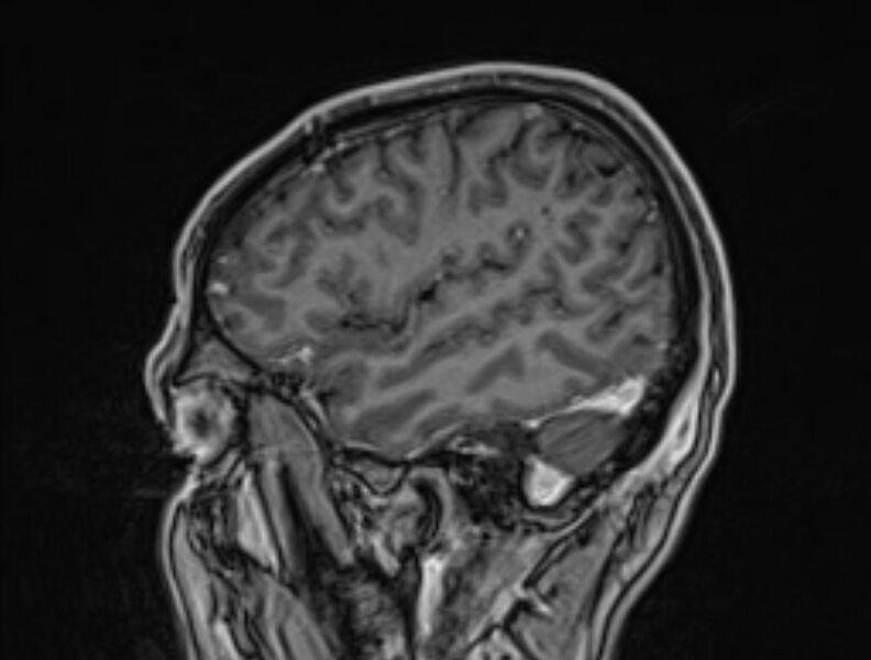 File:Cerebral venous thrombosis (Radiopaedia 71207-81504 Sagittal T1 C+ 52).jpg