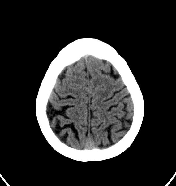 File:Cerebral venous thrombosis - CT only (Radiopaedia 41031-43778 Axial non-contrast 10).jpg
