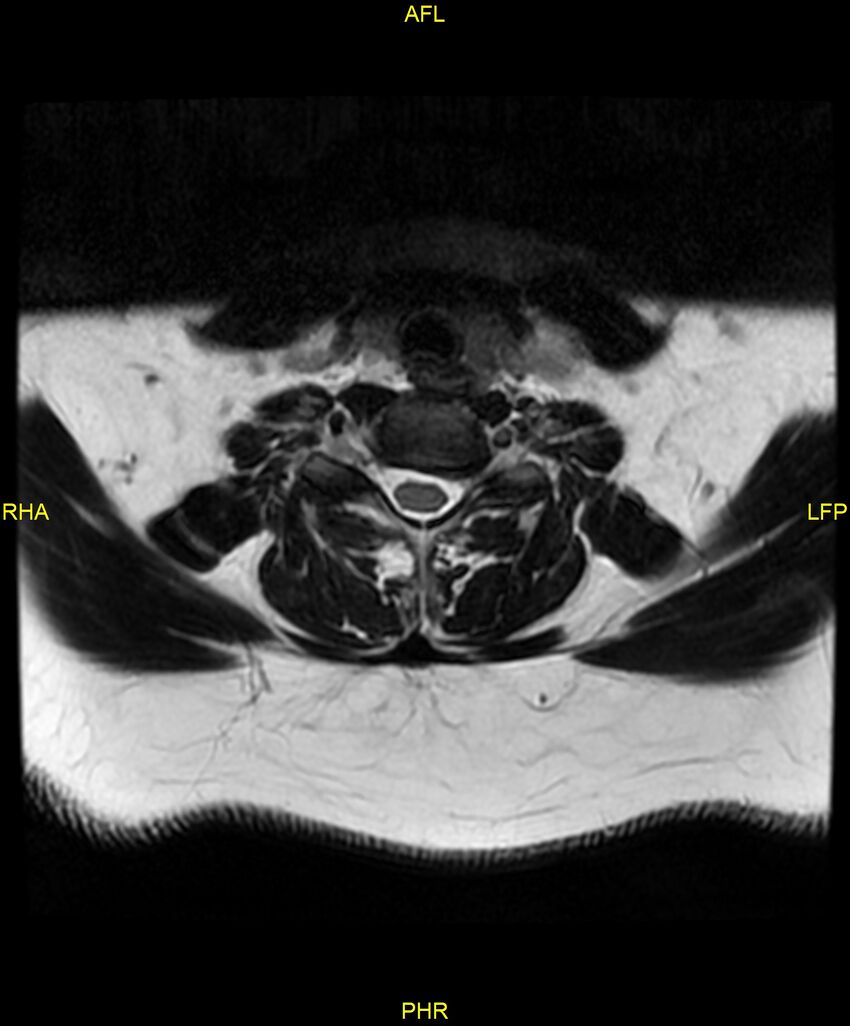 Cervical disc protrusion (Radiopaedia 87147-103415 Axial T2 50).jpg