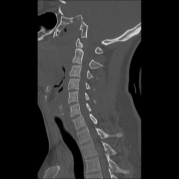 File:Cervical facet fracture and anterior discoligamentous injury (Radiopaedia 32139-33083 Sagittal bone window 15).jpg