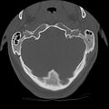 Cervical flexion teardrop fracture with cord hemorrhage (Radiopaedia 32497-33454 Axial bone window 7).jpg