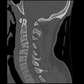 Cervical flexion teardrop fracture with cord hemorrhage (Radiopaedia 32497-33454 Sagittal bone window 23).jpg