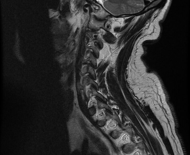 File:Cervical schwannoma (Radiopaedia 72399-82934 Sagittal T2 12).jpg