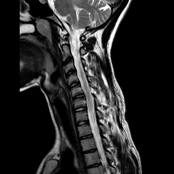 File:Cervical spine posterior ligamentous complex rupture (Radiopaedia 63486-72103 Sagittal T2 5).jpg