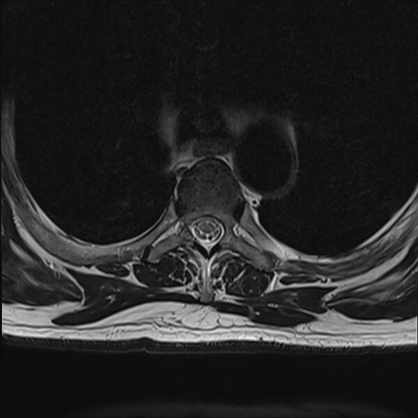 File:Cervical tumor-like myelopathy due to Type V dAVF (Radiopaedia 82461-96604 D 12).jpg
