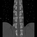 Chance fracture (Radiopaedia 36521-38081 Coronal bone window 32).jpg
