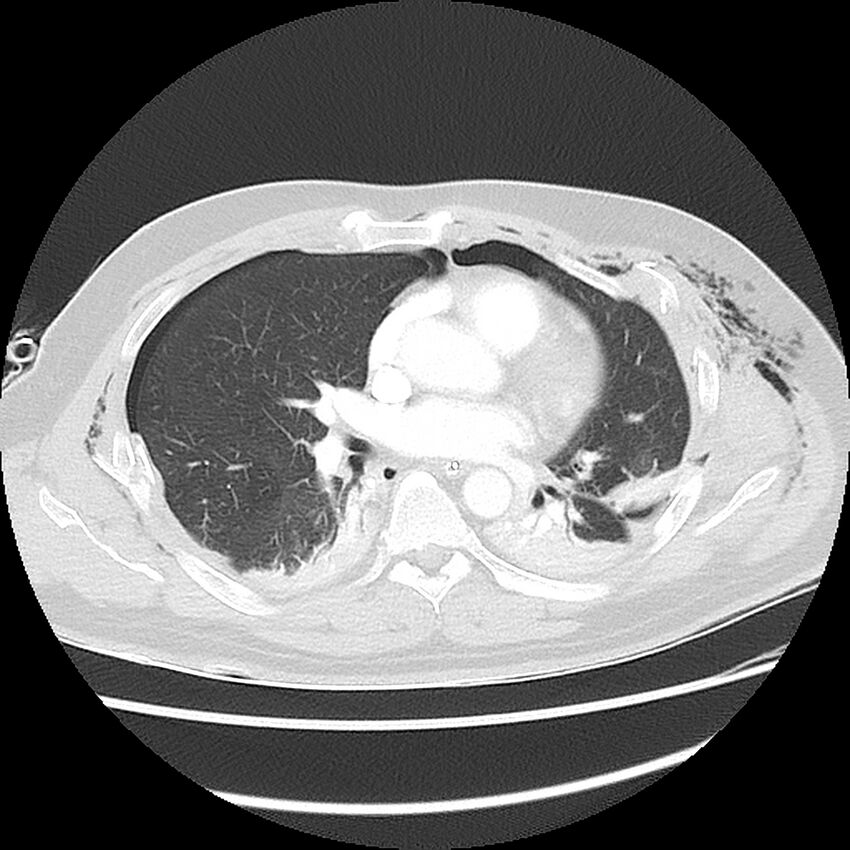 Chest crush injury (Radiopaedia 31620-32513 Axial lung window 31).jpg