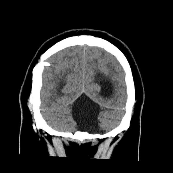File:Chiasmatic-hypothalamic juvenile pilocytic astrocytoma (Radiopaedia 78533-91237 Coronal non-contrast 57).jpg