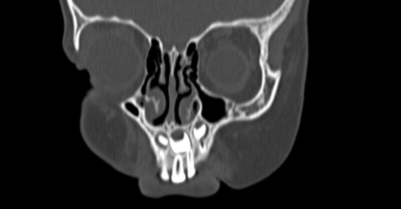 File:Choanal atresia (Radiopaedia 51295-56972 Coronal bone window 9).jpg