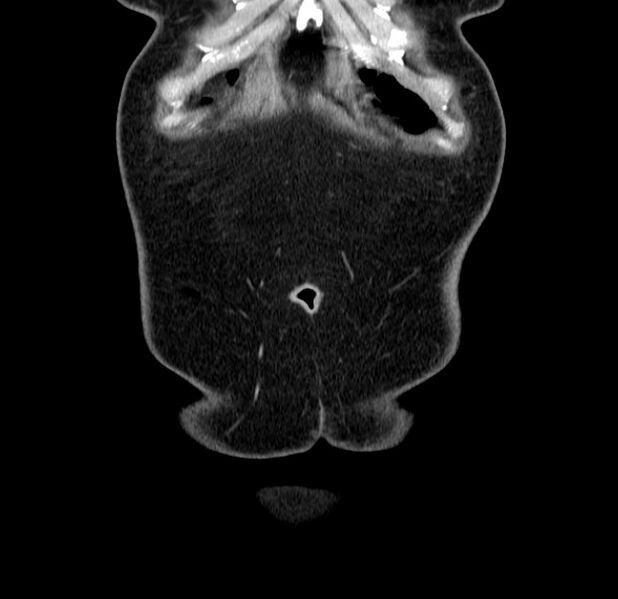 File:Choledocholithiasis on CT and MRI (Radiopaedia 24825-25087 C 3).jpg