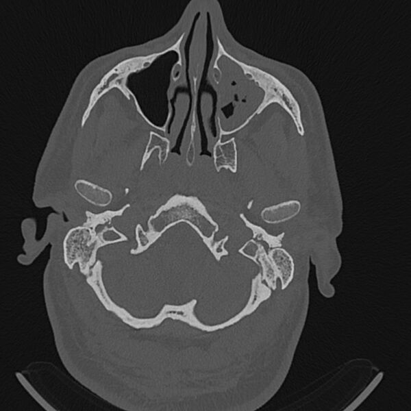 File:Cholesteatoma (Radiopaedia 68176-77673 Axial bone window 2).jpg
