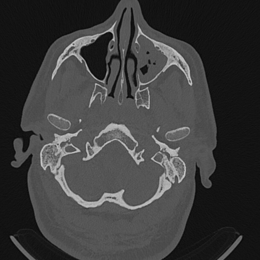 Cholesteatoma (Radiopaedia 68176-77673 Axial bone window 2).jpg
