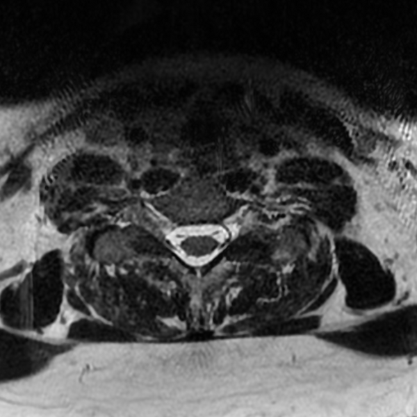 File:Chordoma - cervical spine (Radiopaedia 70084-80111 Axial T2 76).png