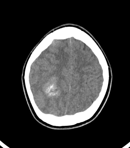 File:Choroid plexus carcinoma (Radiopaedia 91013-108552 Axial non-contrast 49).jpg