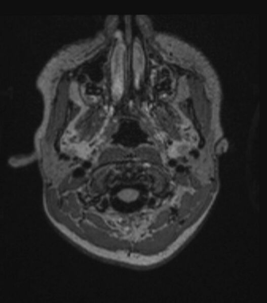 File:Choroid plexus carcinoma (Radiopaedia 91013-108553 Axial FLAIR C+ 65).jpg