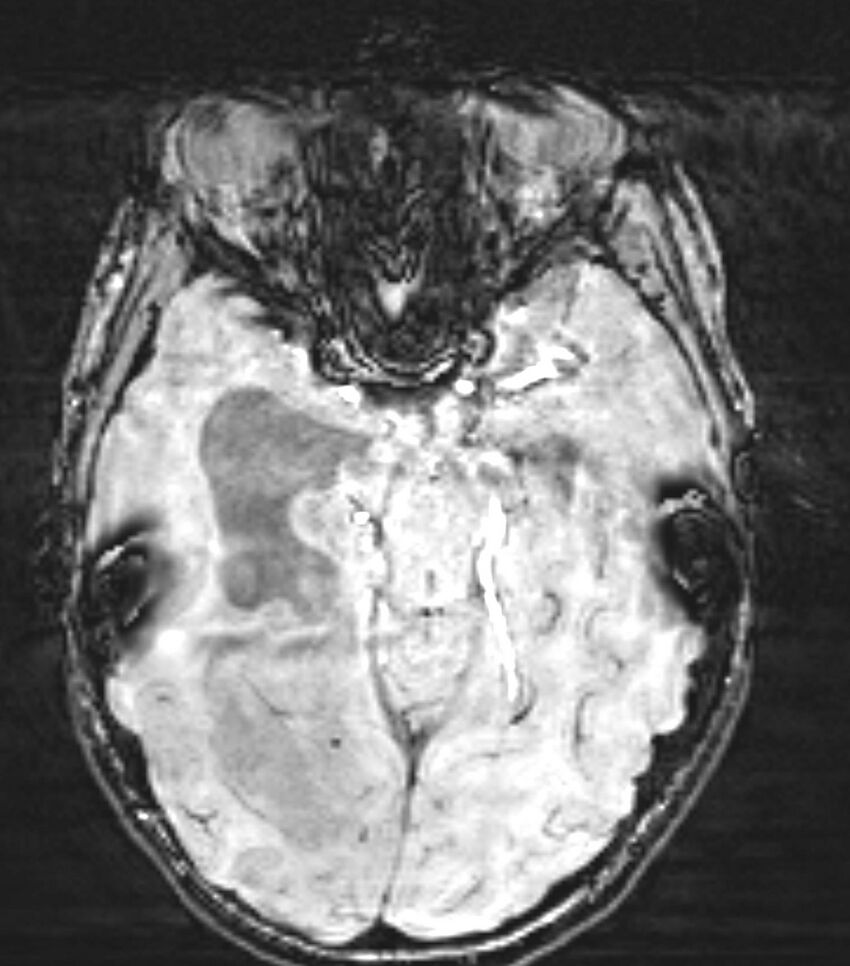Choroid plexus carcinoma (Radiopaedia 91013-108553 Axial SWI 37).jpg