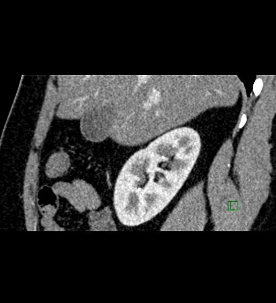 File:Chromophobe renal cell carcinoma (Radiopaedia 84286-99573 F 123).jpg