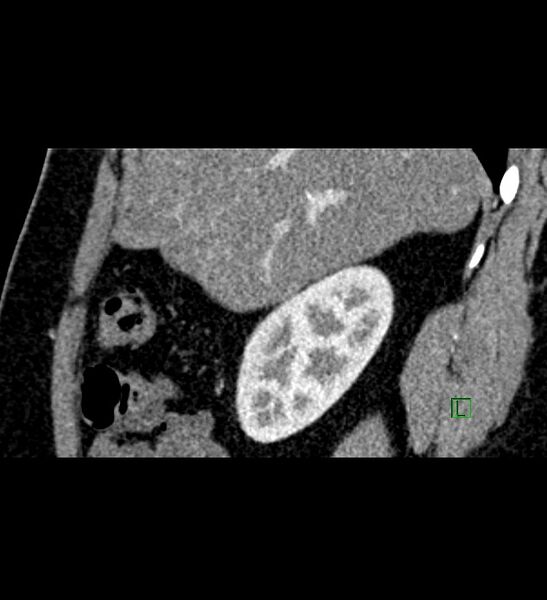 File:Chromophobe renal cell carcinoma (Radiopaedia 84286-99573 F 128).jpg
