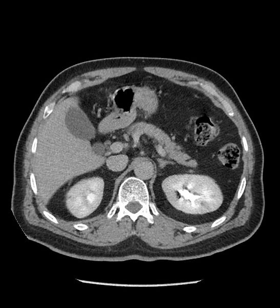 File:Chromophobe renal cell carcinoma (Radiopaedia 86879-103083 D 40).jpg