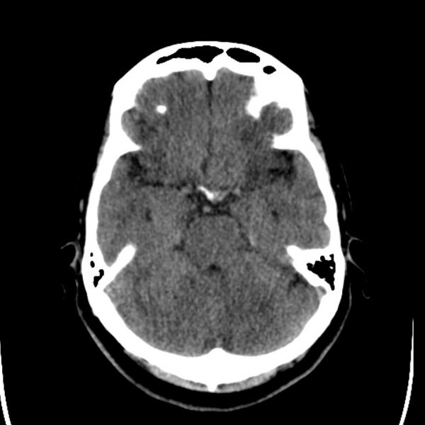 File:Chronic bilateral occipital lobe infarcts (Radiopaedia 31276-31996 Axial non-contrast 14).jpg
