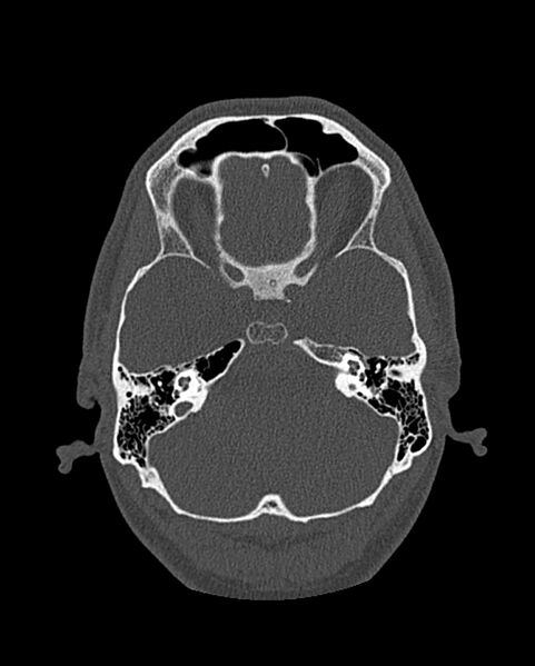 File:Chronic maxillary sinusitis caused by a foreign body (Radiopaedia 58521-65676 Axial bone window 250).jpg
