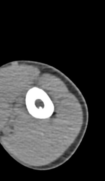 File:Chronic osteomyelitis of the distal humerus (Radiopaedia 78351-90971 Axial 222).jpg