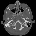 Chronic otomastoiditis (Radiopaedia 27138-27309 Axial bone window 7).jpg