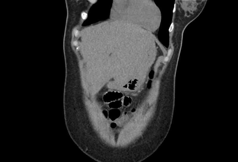 File:Chronic pancreatitis - pancreatic duct calculi (Radiopaedia 71818-82251 Coronal non-contrast 5).jpg