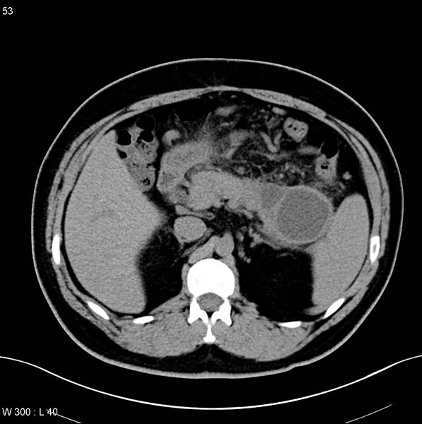 File:Chronic pancreatitis and pseudocysts (Radiopaedia 6724-7935 Axial non-contrast 7).jpg