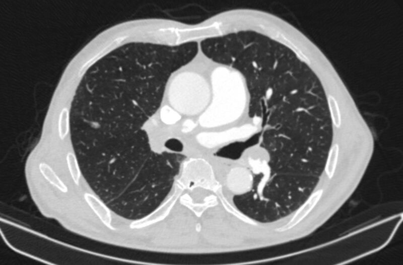 File:Chronic pulmonary embolism (Radiopaedia 91241-108843 Axial lung window 43).jpg