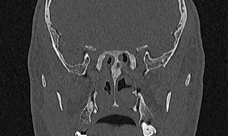 File:Chronic rhinosinusitis (Radiopaedia 65079-74075 Coronal bone window 61).jpg