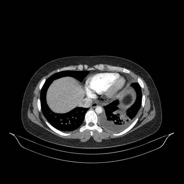File:Chronic thromboembolic pulmonary hypertension (CTEPH) (Radiopaedia 74597-85532 Axial C+ CTPA 44).jpg