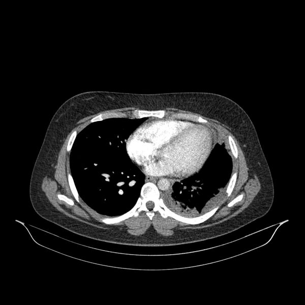 File:Chronic thromboembolic pulmonary hypertension (CTEPH) (Radiopaedia 74597-85532 Axial C+ CTPA 66).jpg