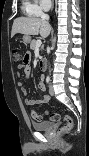 File:Clear cell renal cell carcinoma (Radiopaedia 61449-69393 G 58).jpg