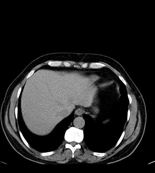 File:Clear cell renal cell carcinoma (Radiopaedia 85006-100539 Axial non-contrast 16).jpg