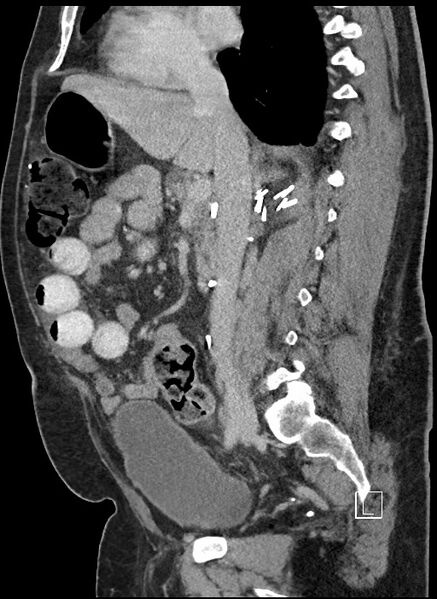 File:Closed loop obstruction - internal hernia into nephrectomy bed (Radiopaedia 59867-67320 C 55).jpg