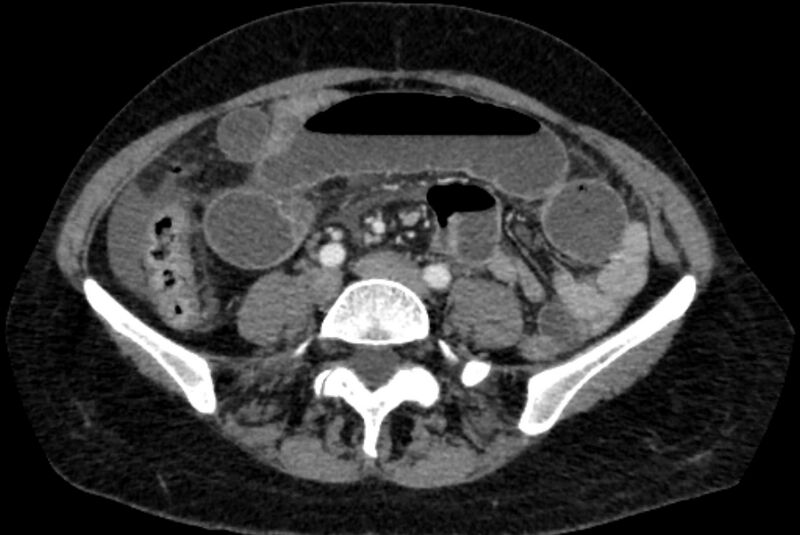 File:Closed loop small bowel obstruction (Radiopaedia 71211-81508 A 85).jpg