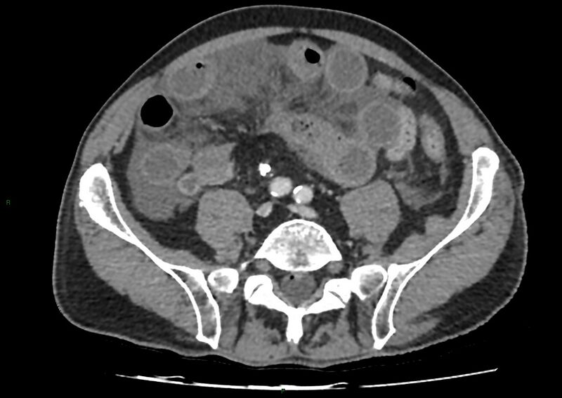 File:Closed loop small bowel obstruction with ischemia (Radiopaedia 84180-99456 A 81).jpg